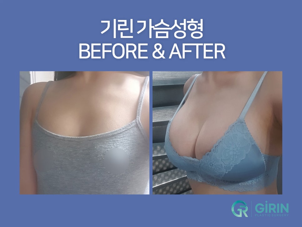 가슴확대수술 효율성 따져보며 관련 이미지 10
