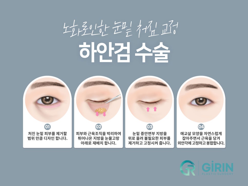 중년눈성형잘하는곳 찾았다면 관련 이미지 9