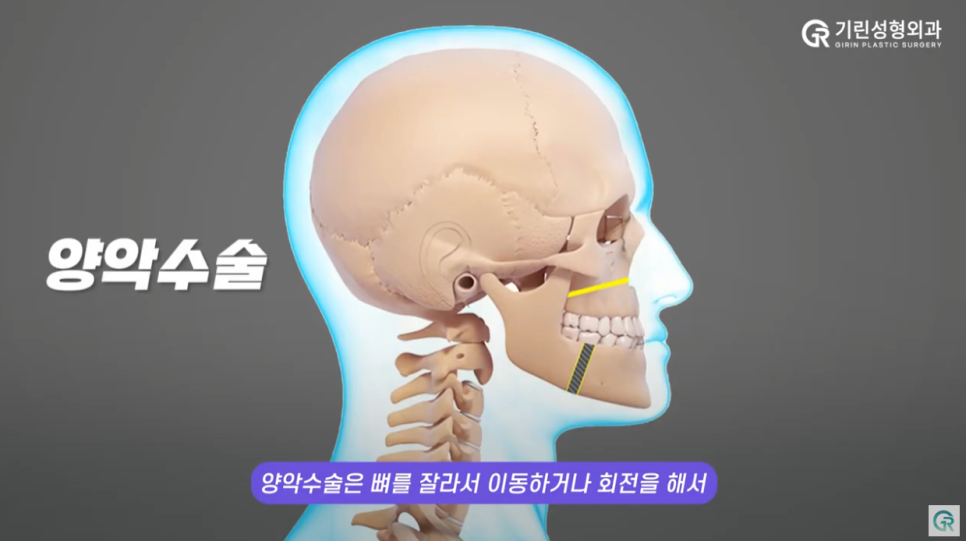 [기린성형외과의원] 얼굴뼈수술 전 필수 시청_초간단 양악수술 자가진단법 관련 이미지 3