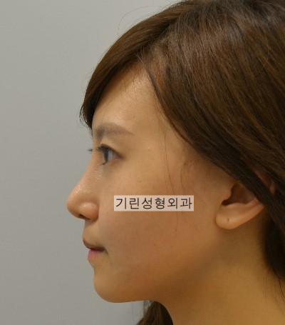 귀족수술과 코수술병행 시 중안면부 볼륨효과 관련 이미지 2