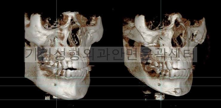 남자긴턱줄임+자가뼈앞턱수술+광대고정 수술다음날CT 관련 이미지 3