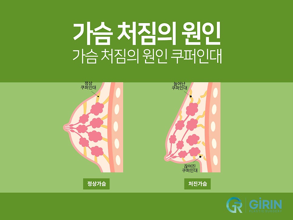 처진가슴수술후기 비교하며 선택한다면 관련 이미지 2