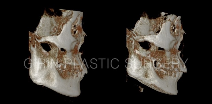 넓은턱 수술사례 관련 이미지 3