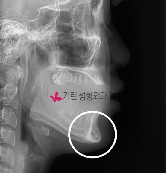 안면윤곽수술의 대표적인 사각턱과 앞턱(엑스레이사진) 관련 이미지 1