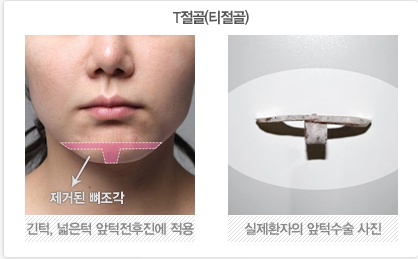 티절골(T절골)과 샌드위치절골(ㅡ자절골) 실제 뼈의 모습. 관련 이미지 1