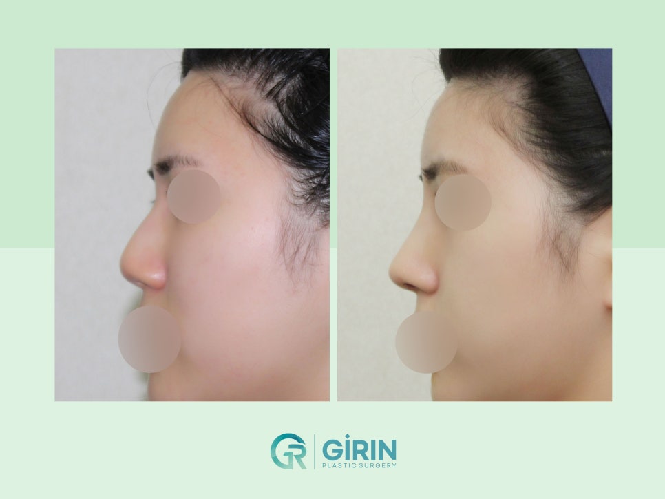 비염코성형 실비 가능성 있기에 관련 이미지 1