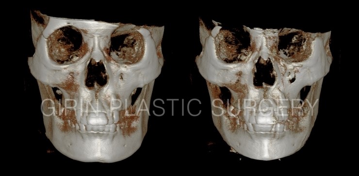 넓은턱 수술사례 관련 이미지 1