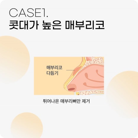 매부리코수술? 콧대만 깎는다고 해결 될까? 관련 이미지 5