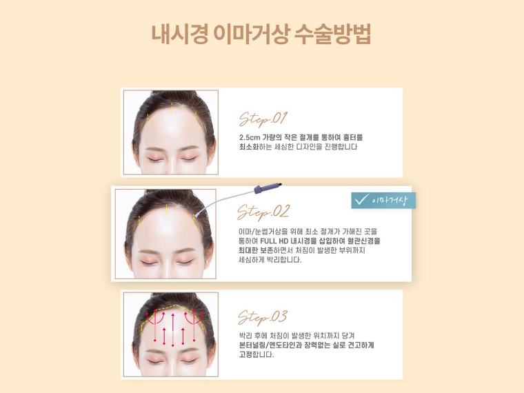 내시경이마거상 탄력 고민을 해결하는 관련 이미지 6