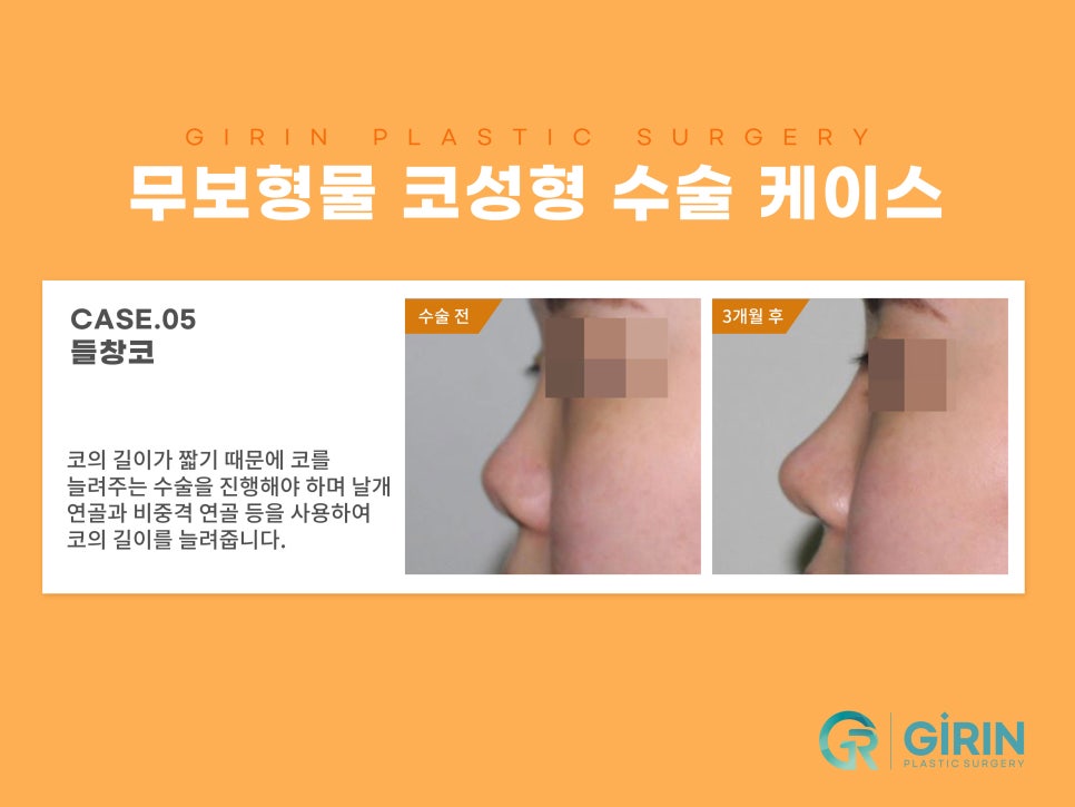 무보형물 코수술 자연스러운 코라인 관련 이미지 9