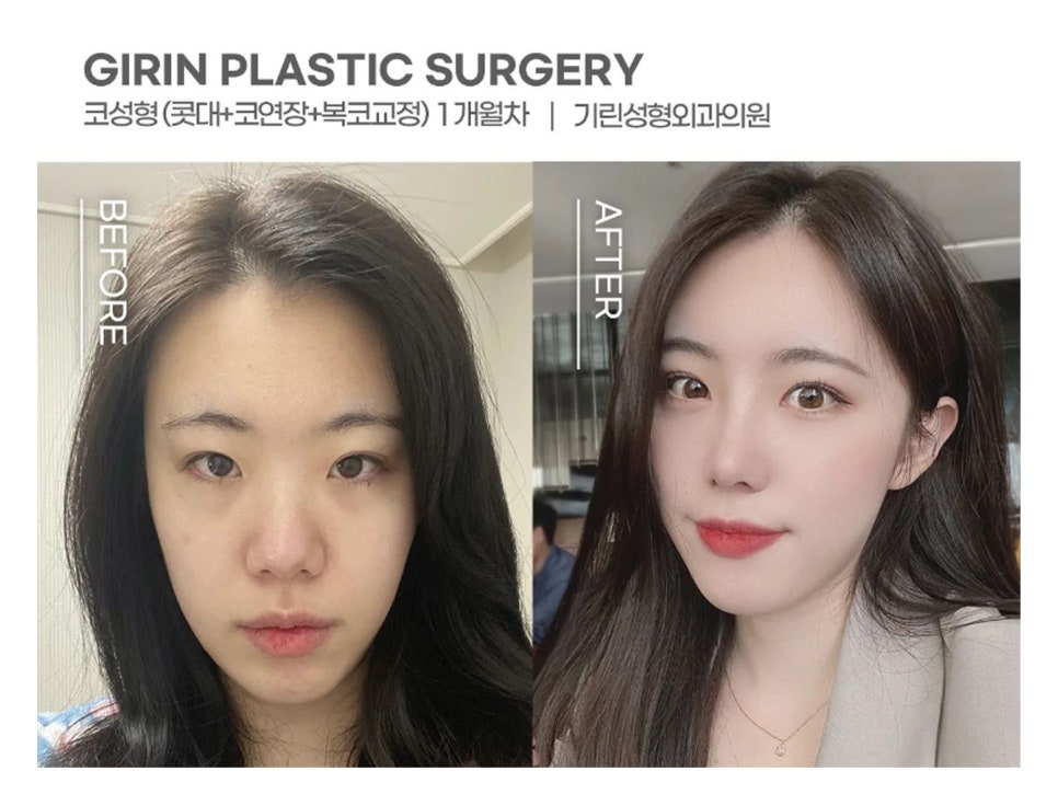 논현성형외과 낮은 콧대 고민은 관련 이미지 1