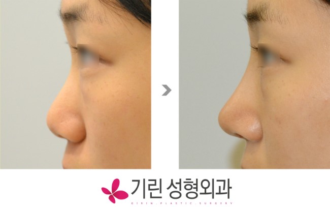 복코성형 : 콧대실리콘 높이는 어떻게 판단하나 관련 이미지 1