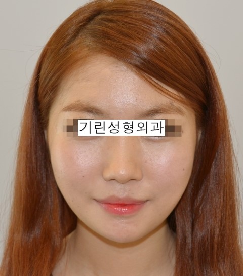 최소박리로 진행되는 옆광대뼈축소술 관련 이미지 2