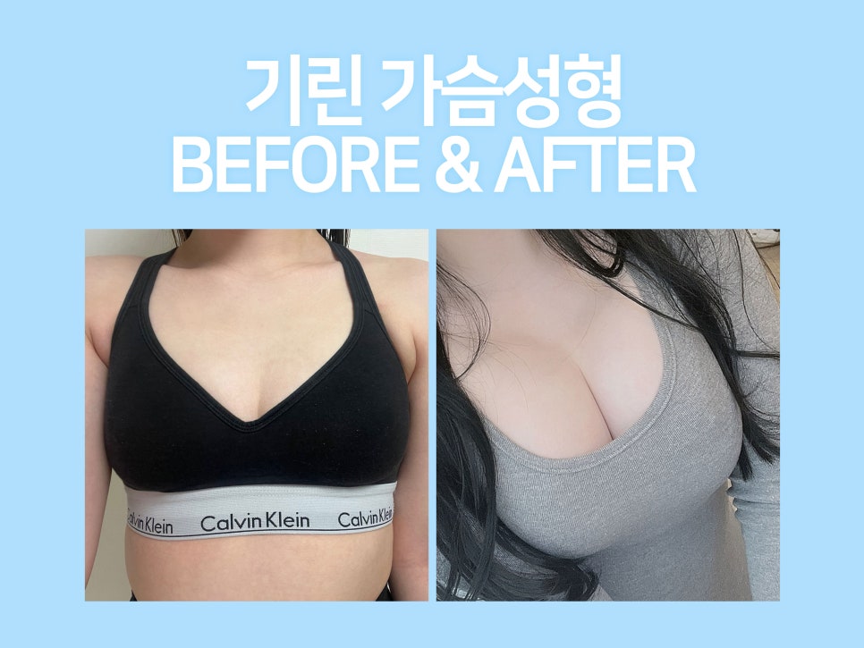 가슴확대수술 효율적으로 개선을 관련 이미지 2