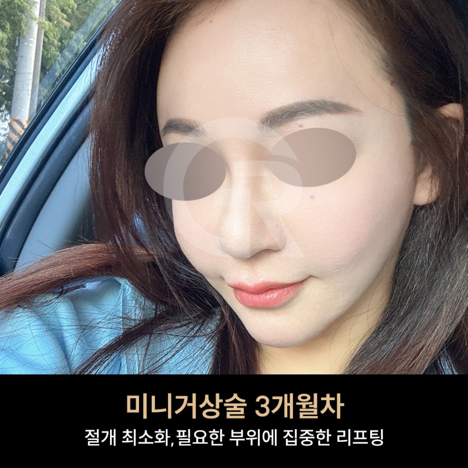 위고비&middot;마운자로 후 얼굴처짐으로 인한 미니거상 후기 관련 이미지 8