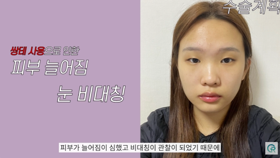[기린성형외과] 작고 답답한 눈, 뭉뚝하고 낮은 복코 탈출!_눈성형, 코성형 수술일지 관련 이미지 7