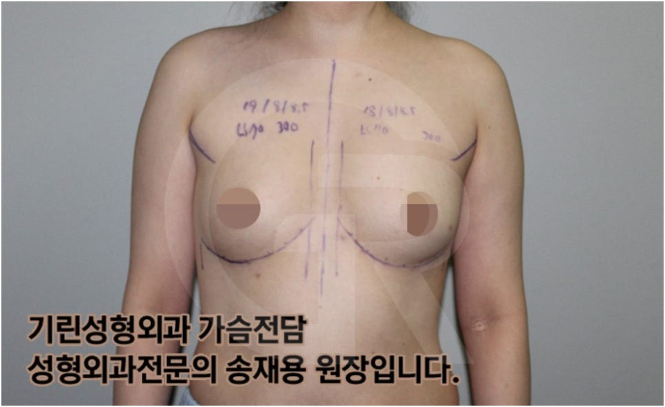 가슴확대수술 후 관리방법, 실제사례 알아보다. [기린성형외과의원_Dr.송재용] 관련 이미지 4