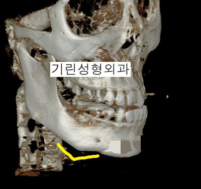 잘못된 수술진단으로 인한 이차각사례 관련 이미지 1
