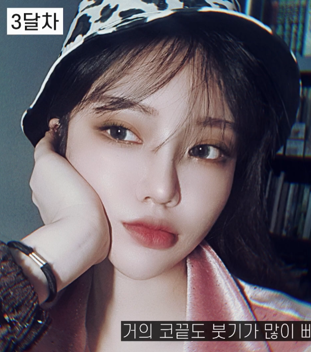 [기린성형외과의원] 코성형 전 코필러 하셨나요?_작은 코성형 수술일지 관련 이미지 7