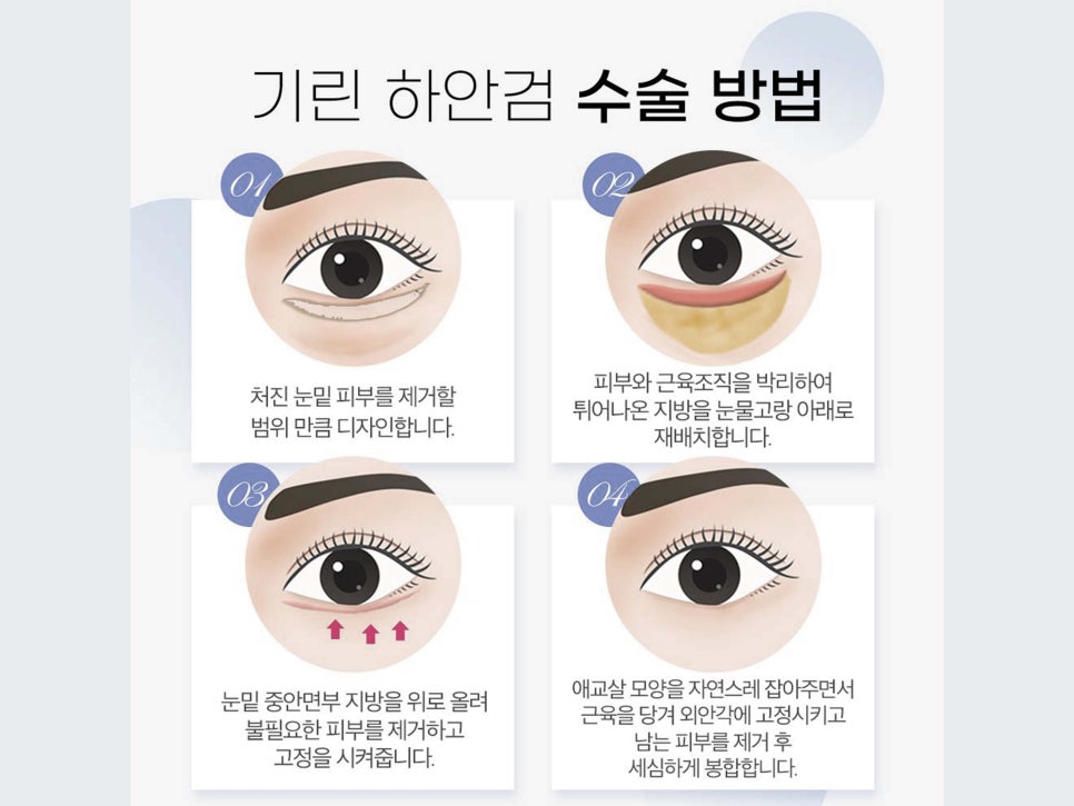 상안검하안검수술 빠른 회복을 위해 관련 이미지 7