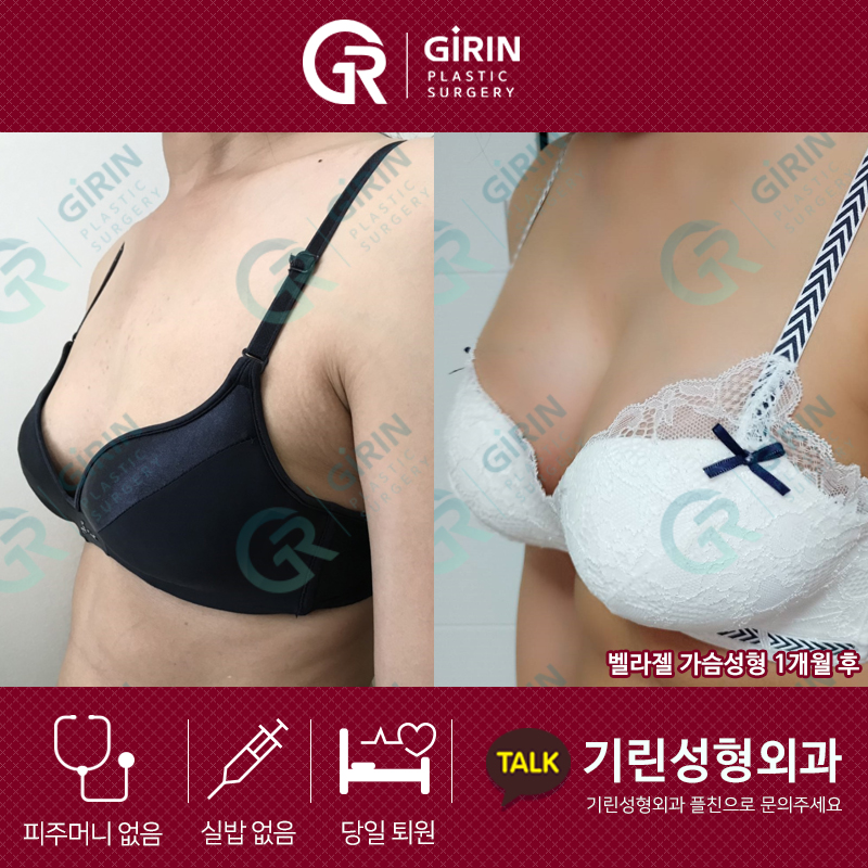 처진 가슴도 한방에! 기린 성형외과 송재용 원장 가슴 수술 후기 관련 이미지 2
