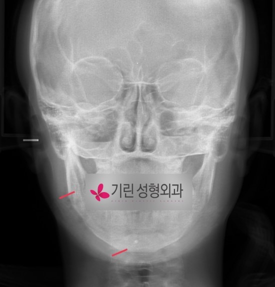 사각턱수술case (귀밑사각 부터 앞턱끝까지) 관련 이미지 2
