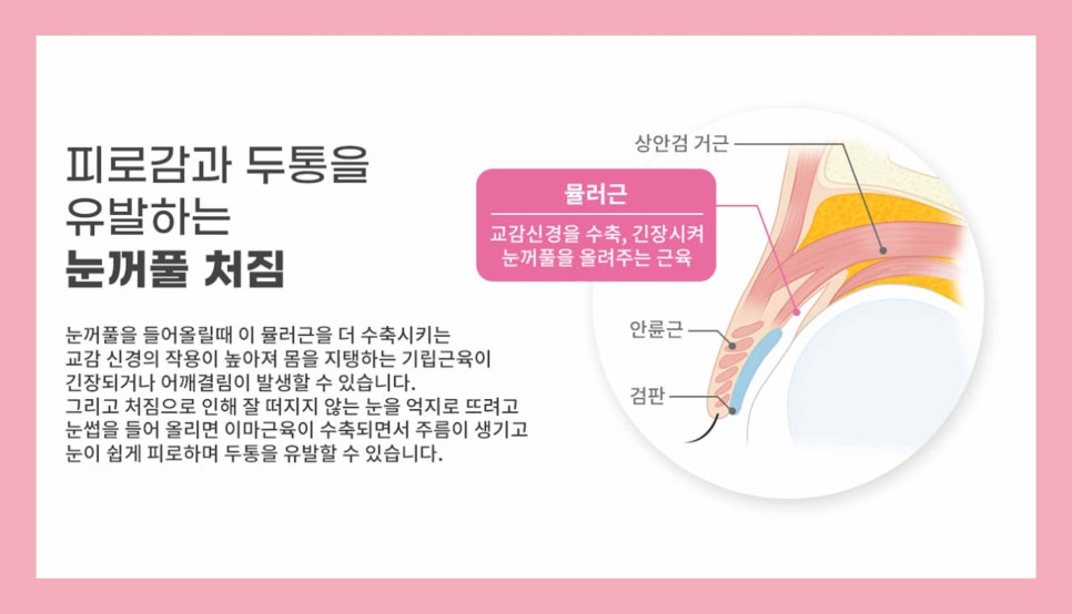 처진눈수술 눈매를 바꾸는 방법 관련 이미지 7