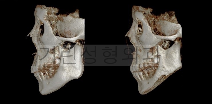 퇴원시 촬영한 긴곡선사각턱 CT영상/ 8일차 경과사진 관련 이미지 6