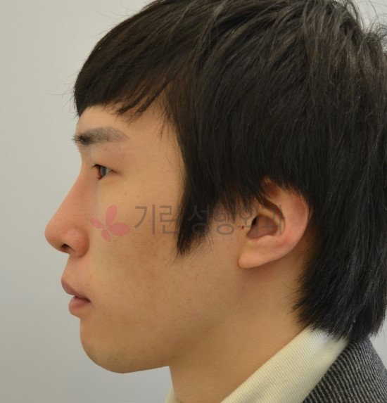 돌출입을 코성형으로 교정한다? [돌출입수술 솔루션 01] 관련 이미지 2