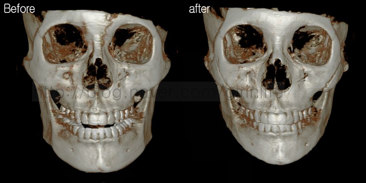 광대 부분절골- 광대비고정사례 관련 이미지 1