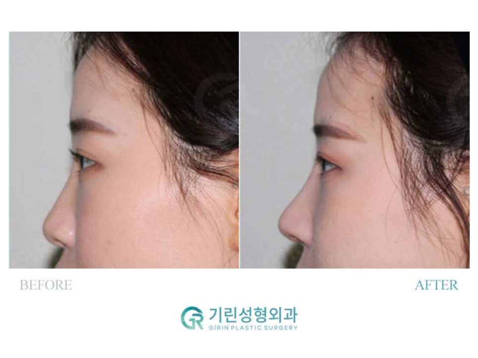 서울코수술 생김새에 따라 다르게 관련 이미지 13