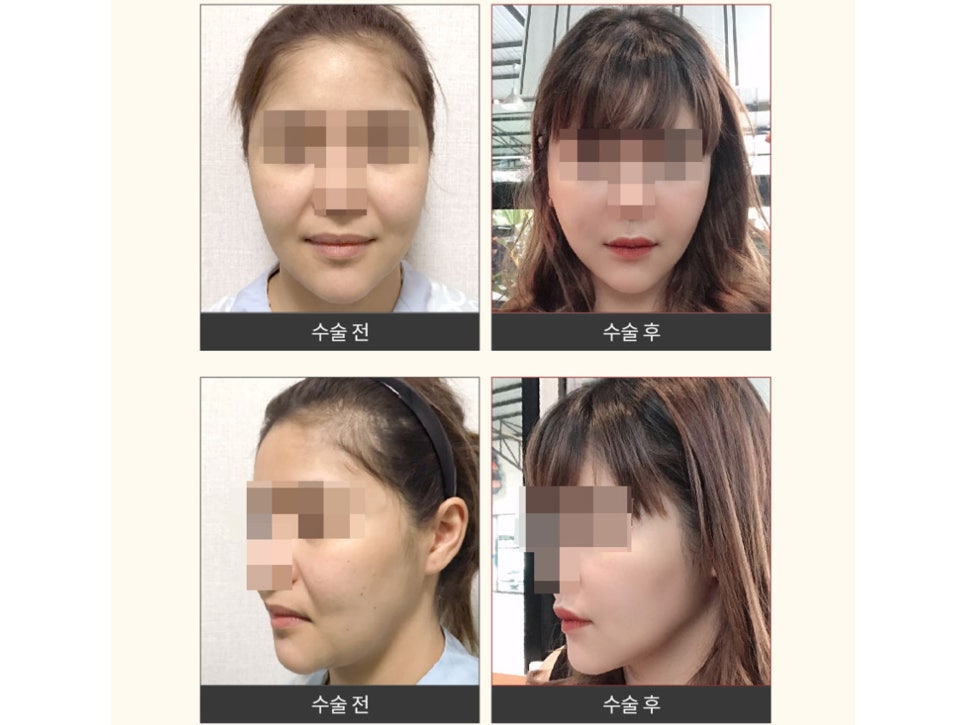 안면거상술효과 기대하는 변화 관련 이미지 12