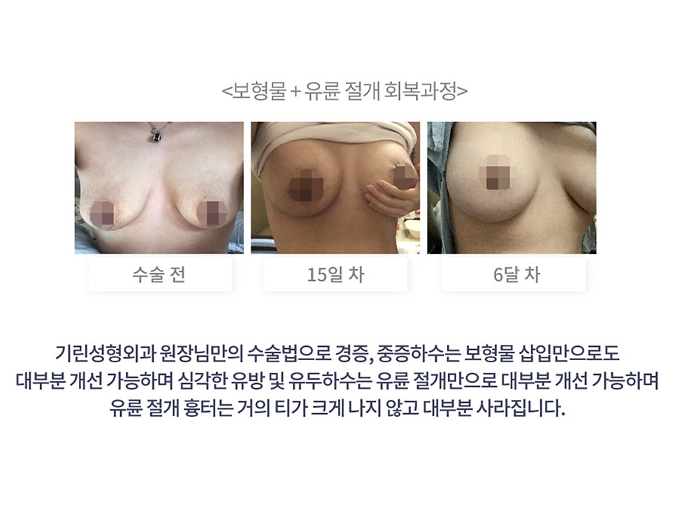 출산후 가슴수술 필요하다 느낀다면 관련 이미지 6