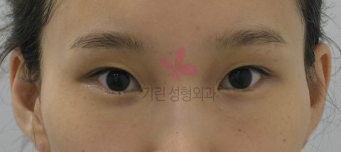 광대뼈와 뒤트임수술의 시너지효과 관련 이미지 1