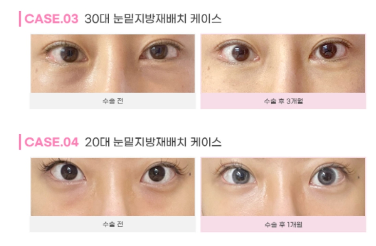 눈밑지방제거수술 하안검 선택의 폭이 넓어졌어요! 관련 이미지 7
