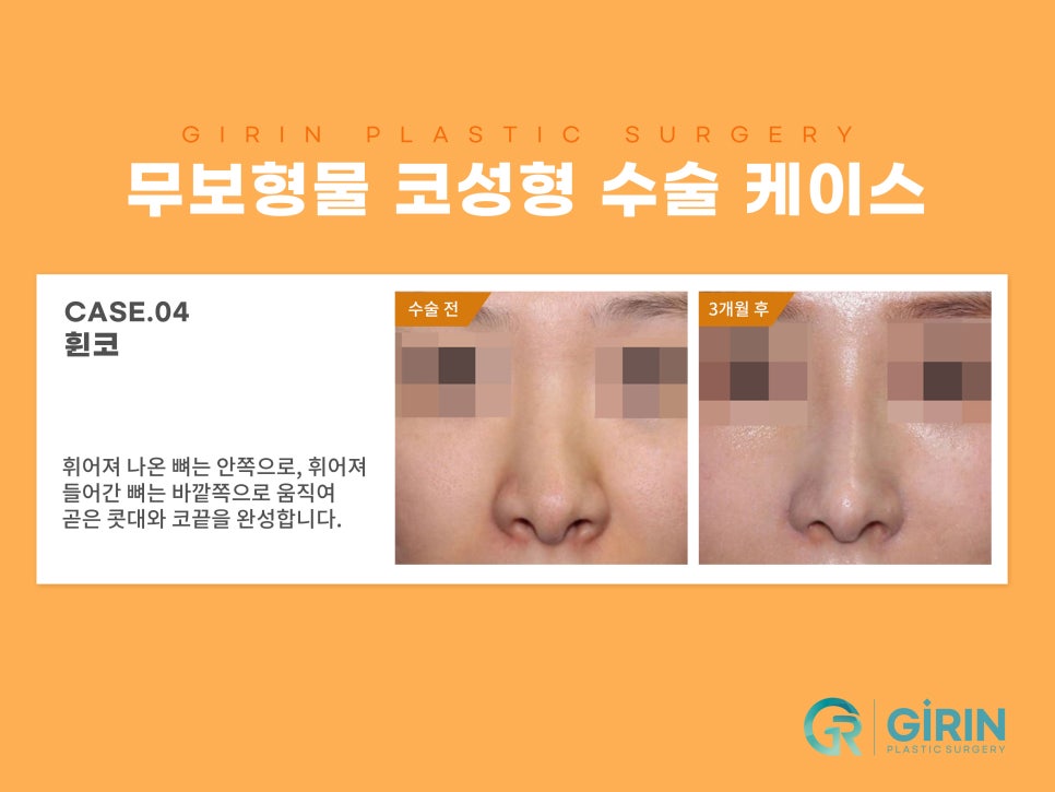 무보형물 코수술 자연스러운 코라인 관련 이미지 8