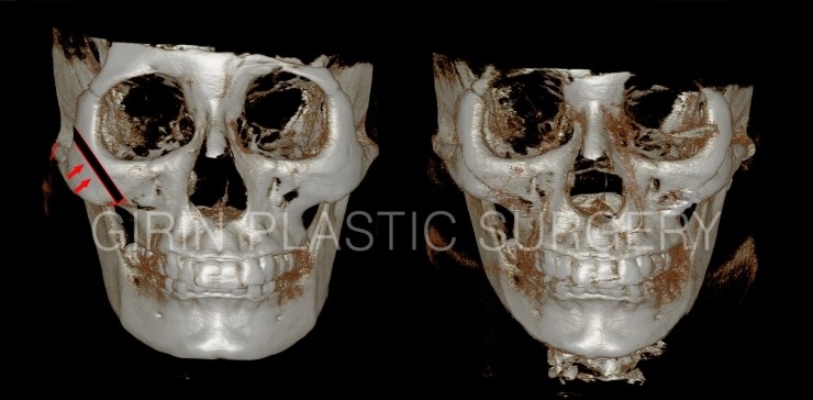 광대축소 불유합과 L절골에 대해 관련 이미지 8
