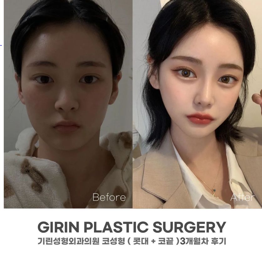 낮은코수술 눈에 보이는 차이를 원한다면 관련 이미지 4