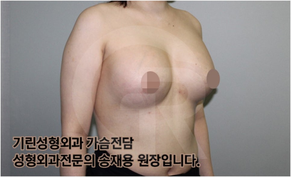 가슴확대수술 후 관리방법, 실제사례 알아보다. [기린성형외과의원_Dr.송재용] 관련 이미지 12