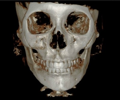 안면윤곽재수술 시 고려해야 할 점 관련 이미지 2