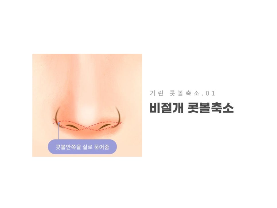 콧볼축소수술전후 얼마나 달라질까 관련 이미지 4