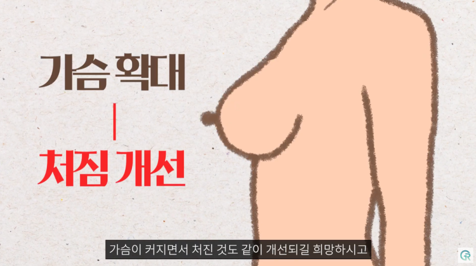 [기린성형외과의원] 다이어트 후 작고, 처진가슴 개선방법_가슴성형 수술일지 관련 이미지 4