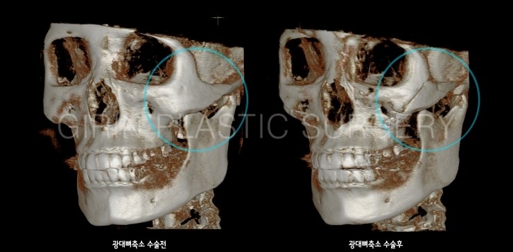 앞광대가 크게 발달한 유형 관련 이미지 4