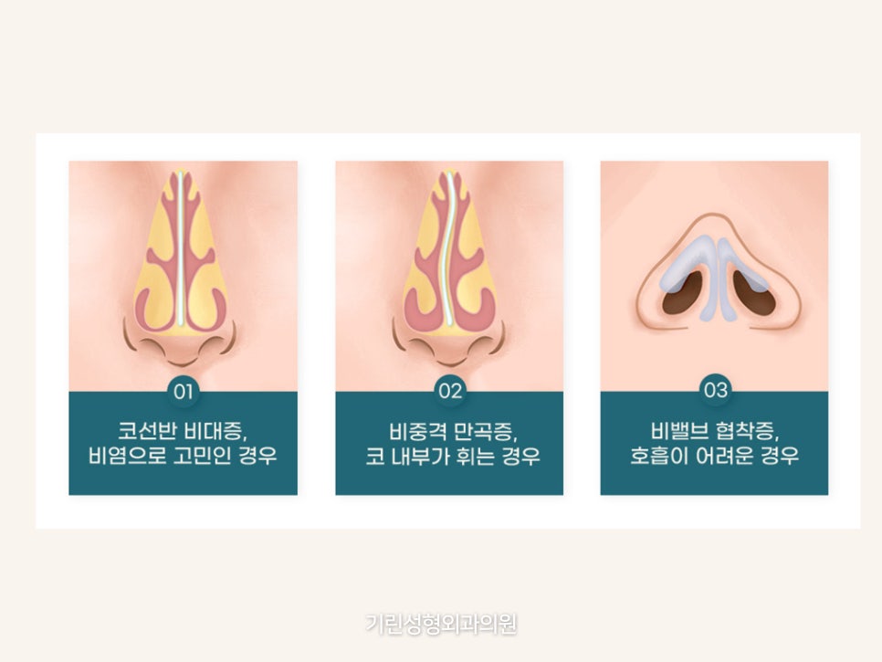 비중격만곡증코성형 같이 진행하고 싶으면 관련 이미지 9