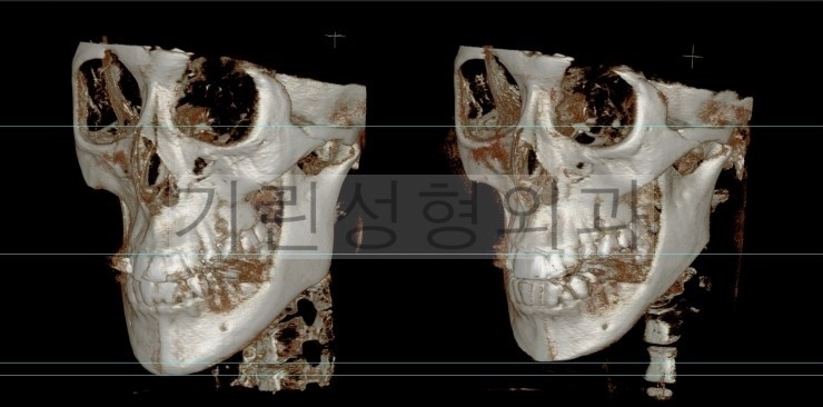 뉴브이라인 긴턱축소 사례 관련 이미지 2