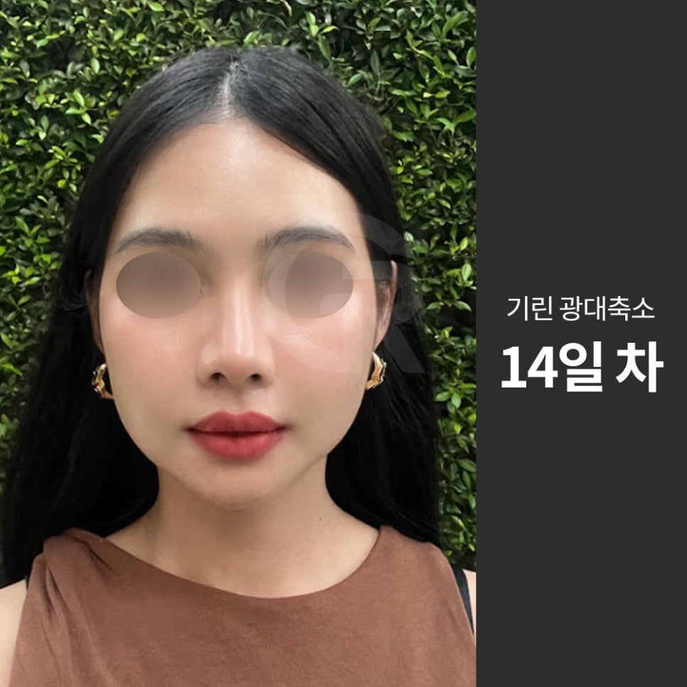 광대가 큰 얼굴, 축소술은 인상을 조율하는 기준점입니다 관련 이미지 3