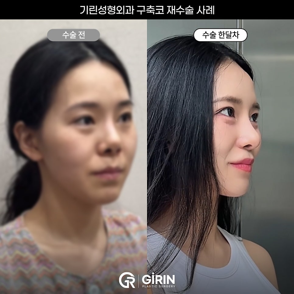 기린성형외과 코성형 구축코 재건 사례 관련 이미지 6