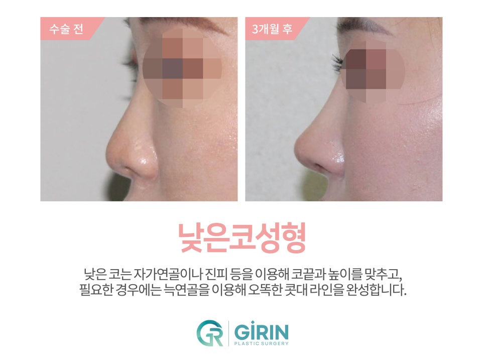 여자코수술 모양도 고려하여 관련 이미지 7