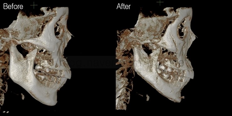 긴곡선절골로 앞턱길이를 함께 줄인 경우 관련 이미지 4