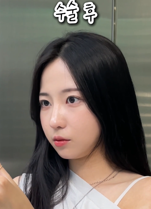 강남역 근처 쌍꺼풀 잘하는 곳 어디? 생생한 후기 관련 이미지 8